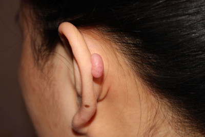 Keloid di Telinga, Bagaimana Cara Menghilangkannya?